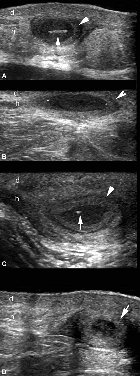 Color Doppler Ultrasound Assessment Of Morphology And Types Of