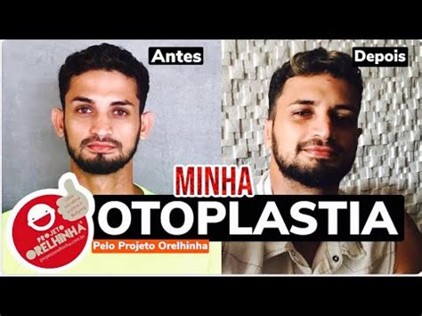 Minha Cirurgia De Otoplastia Projeto Orelhinha Youtube