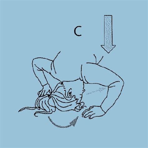 Half Somersault Or Foster Maneuver A Diy Home Exercise For Vertigo In