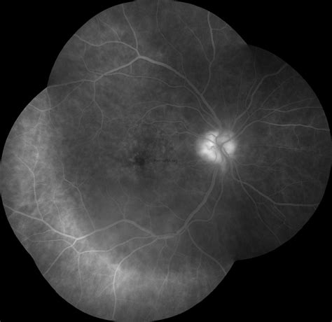 Irvine Gass Syndrome Pseudophakic Cystoid Macular Edema Retinara