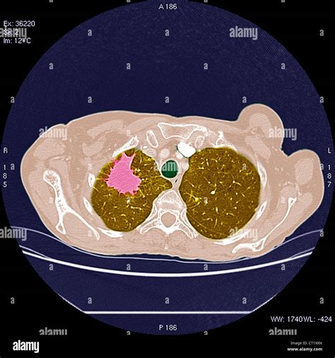 LUNG CANCER, SCAN Stock Photo - Alamy