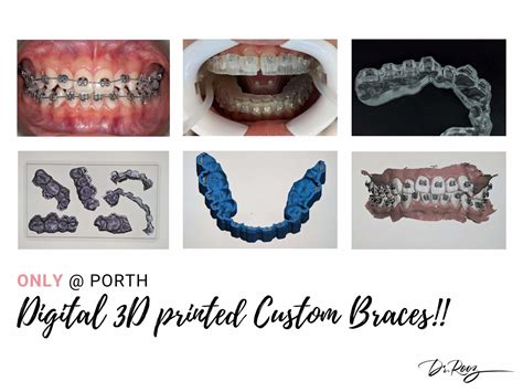 Digital Custom Braces | Modern Orthodontic Clinic