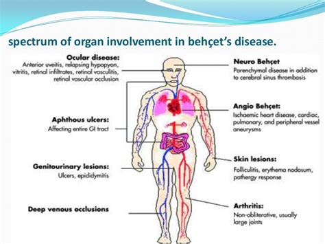 Behcet's disease