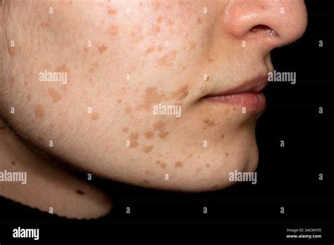 Disseminated Flat Warts Verruca Plana On The Skin Of The Face In A