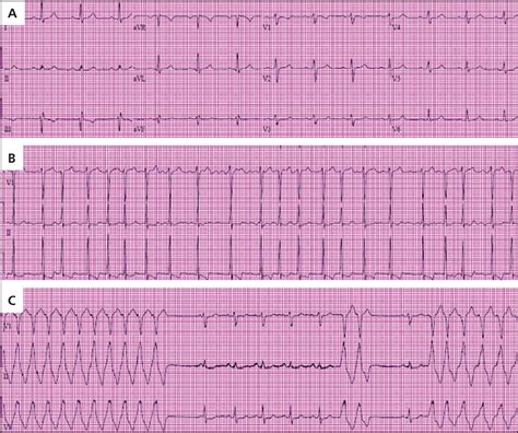 Outpatient Approach To Palpitations Aafp