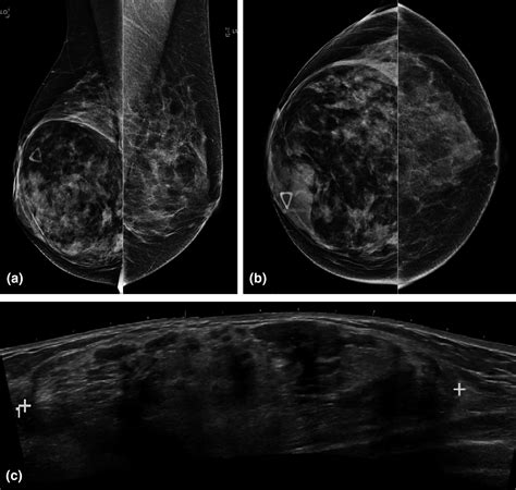 Giant Breast Masses A Pictorial Essay Chitty 2019 Journal Of Medical Imaging And