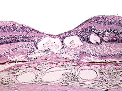 Cystoid Macular Edema Histology