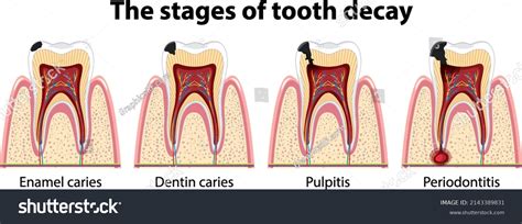 Tooth Decay Diagram