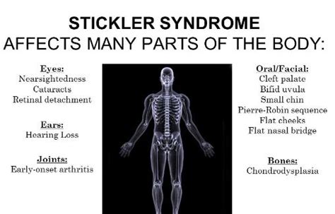 Stickler Syndrome - Pictures, What is?, Life Expectancy, Symptoms, Treat