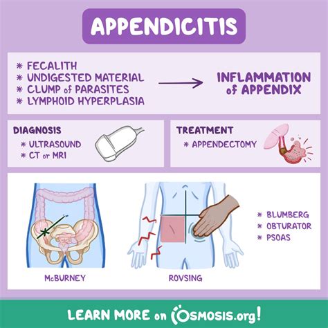 Osmosis From Elsevier On Twitter Appendicitis Is The Inflammation Of