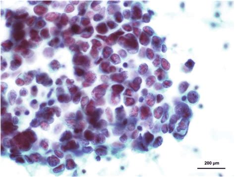 Fine Needle Aspiration Biopsy Fna Revealed That The Individual Cells