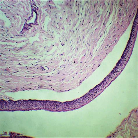 Photomicrographs Of Hande Show Okc With Satellite Cyst With Keratin In