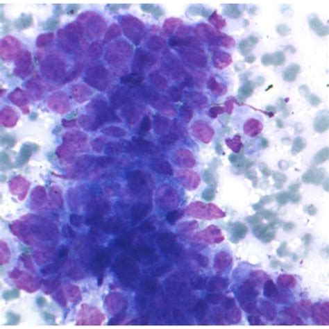 Mediastinal Lymph Node Cytology Of A Nsclc Patient Microscopical Download Scientific Diagram