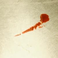 good article health hematidrosis  sweat blood diseases