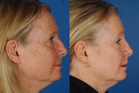 Denver Laser Brown Spot Removal Raval Facial Aesthetics