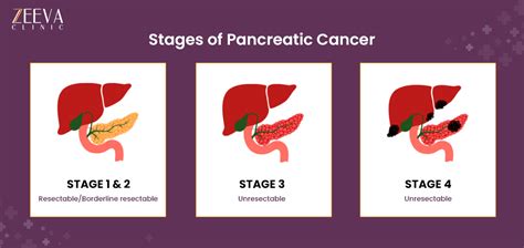 Immunotherapy in Pancreatic Cancer- Power Your Immune System