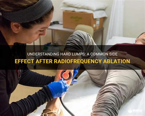 Understanding Hard Lumps A Common Side Effect After Radiofrequency Ablation Medshun