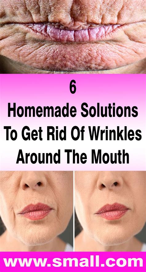 Homemade Solutions To Get Rid Of Wrinkles Around The Mouth