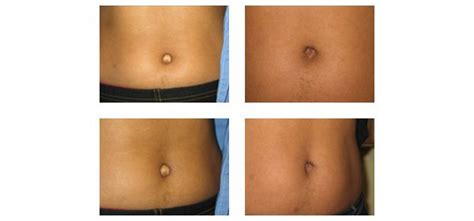 Belly Button Surgery Photos | Belly button tattoo, Belly button, Belly button piercing jewelry