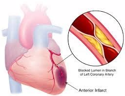 Sintomi Infarto Segni Per Riconoscere Un Attacco Di Cuore