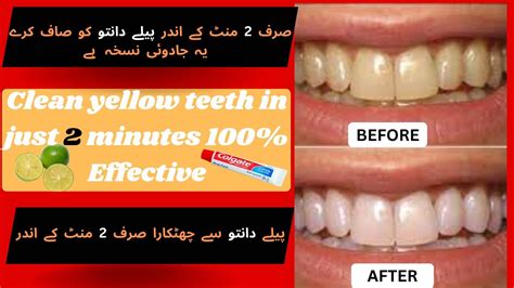 How To Naturally Whiten Your Yellow Teeth Cleans Yellow Teeth In Just 2 Minutes Teeth