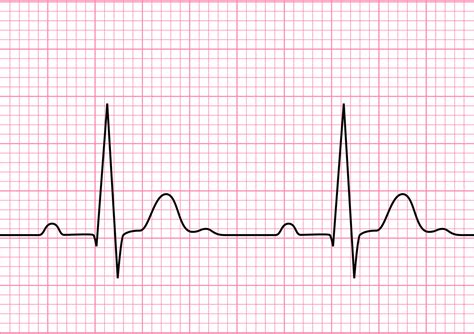 Diagram Of Normal Ekg