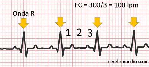 How To Determine Heart Rate On Ecg Cerebro Medico