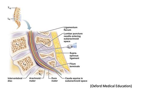 Ultrasound Guided Lumbar Puncture Core EM