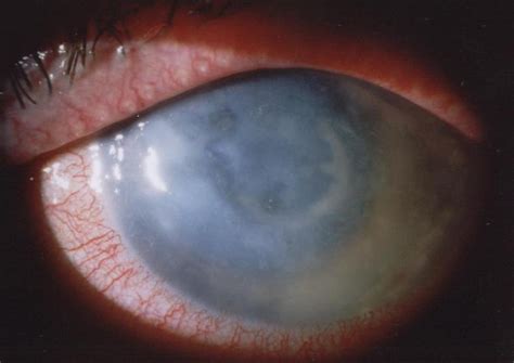 Figure 1 From Understanding Acanthamoeba Keratitis An In Depth Review Of A Sight Threatening