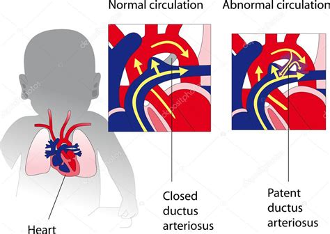 Offener Ductus Arteriosus Botalli Medizin Poster — Stockvektor 6957858