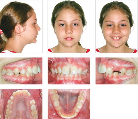 Class Ii Malocclusion