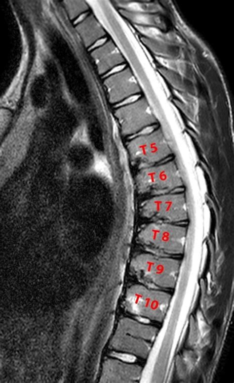 Scheuermann’s Disease Sattvik Spine Spine Surgeon