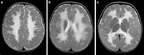 white matter disease mri Mri lesions diffuse axial - Diseases Club center