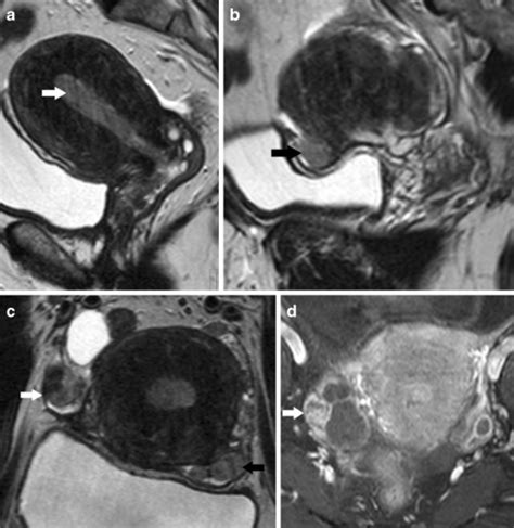 Endometrial Cancer Stage Iiia A Sagittal And B Para Sa Open I