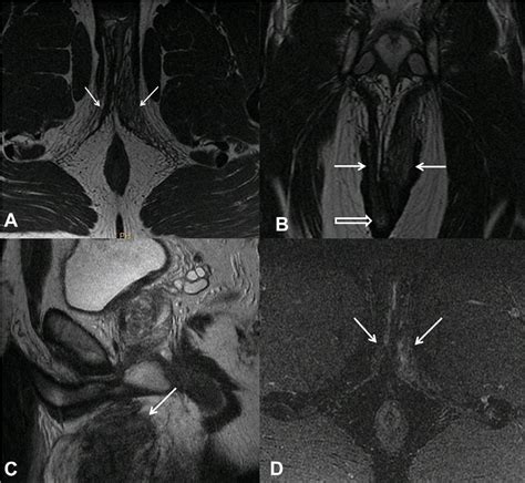 Figure 2 From Mr Imaging Findings In Perineal Nodular Induration