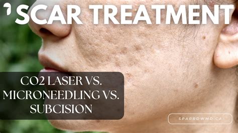 Co2 Laser Vs Microneedling Vs Subcision Youtube