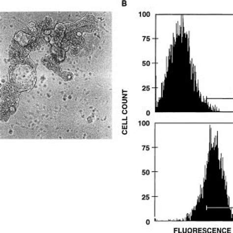 Characterization Of Hcc Cells Recovered By Peritoneal Lavage After