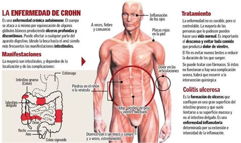 La Enfermedad De Crohn Clinica Yecla