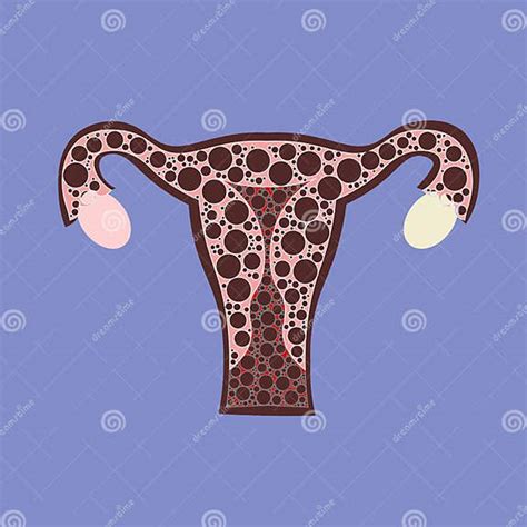 Malignant Neoplasm Arising From Cells In The Cervix Uteri Stock