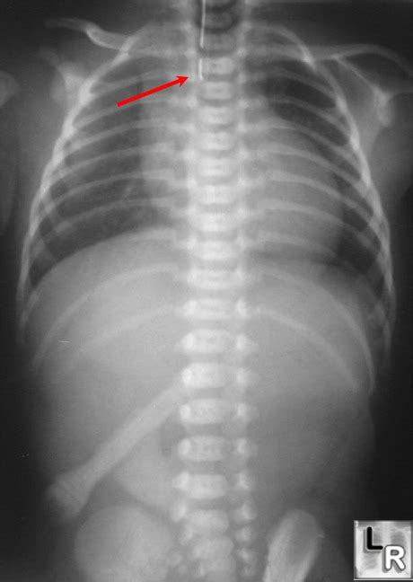 Tracheoesophageal Fistula Ultrasound