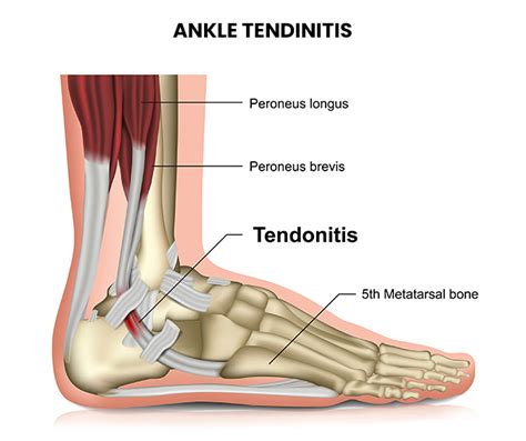 Ankle Tendinitis Njs Top Orthopedic Pain And Spine Practice In New Jersey