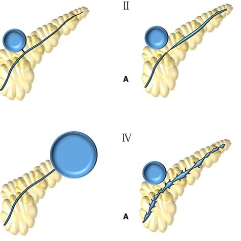 Nealon Et Al 37 2009 Classification Type I Normal Main Pancreatic