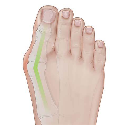 Bunions 101 Symptoms — Phantom® MIS Solution