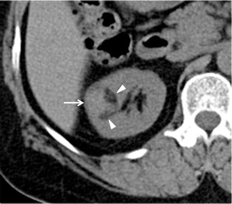 New Radiologic Classification Of Renal Angiomyolipomas European