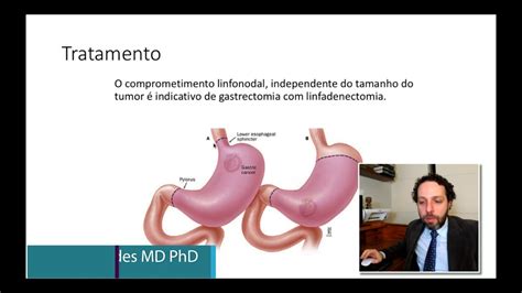 Dr Felipe Ades C Ncer De Est Mago Como Realizado O Tratamento