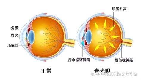 青光眼笔记一，世界范围内第一位的不可逆性致盲眼病 - 知乎