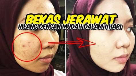 Cara Menghilangkan Bekas Jerawat Dengan Cepat Dan Mudah Dalam Hari