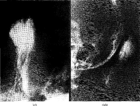 Figure From A Case Of Scalp Cavernous Hemangioma Simulating Sinus