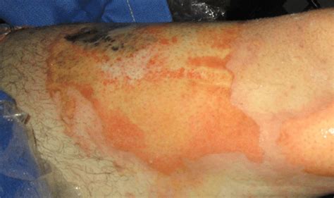 Case No 8 Image Of Patients Thigh With Mottled Area Of Deeper Burn