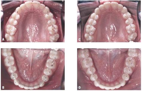 Bueno Ortodontia Ajuste Oclusal Na Ortodontia Por Que Quando E Como